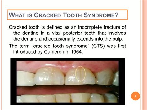Cracked tooth syndrome | PPTX