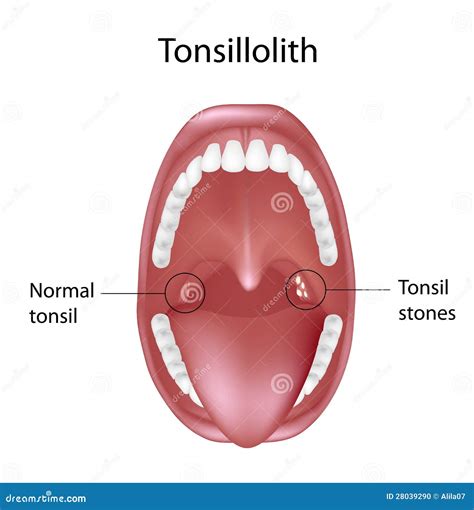 Tonsil stones stock vector. Illustration of halitosis - 28039290