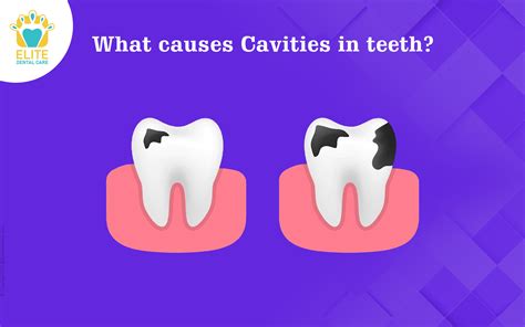 Cavities In Teeth