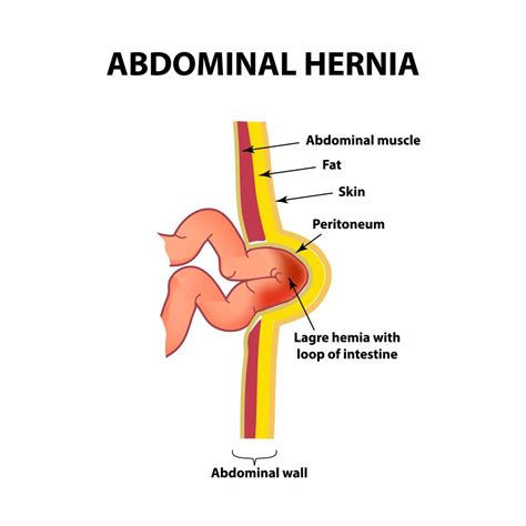 Tipos De Hernias En Hombres – Tipos De Hernias – GCZNU