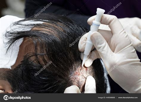 Hair Transplantation Process Pulling Hair Follicles Back Replanting Them — Stock Photo ...