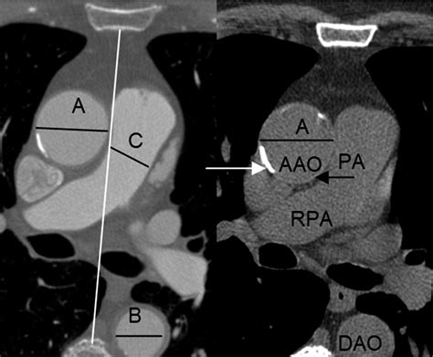 Normal Thoracic Aorta Diameter on Cardiac Computed Tomography in Healthy Asymptomatic Adults ...