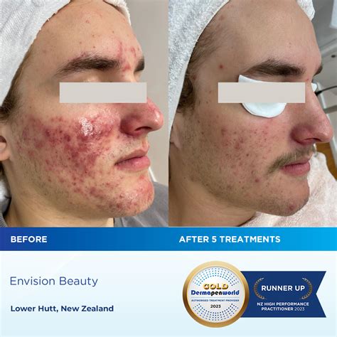 Severe Acne Scars Microneedling