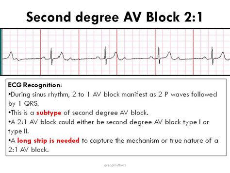 2nd Degree AV Block Rhythm Strip
