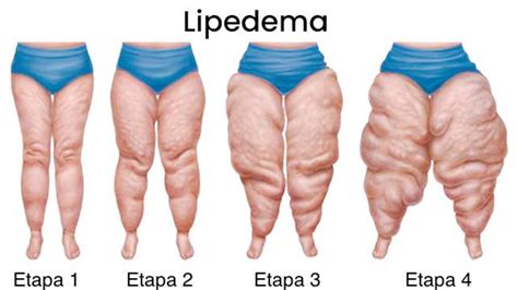 Que Es Lipedema