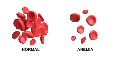 12 anemia PSD, High Quality Free PSD Templates for Download | Freepik
