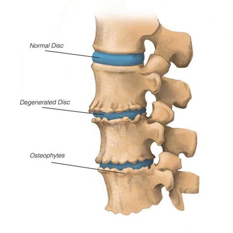 What Is A Disc Spur Complex at Charles Mcclelland blog