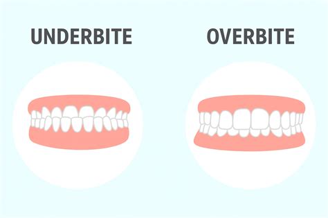 Overjet vs Overbite | What’s the Difference?