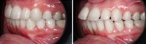 Class II Malocclusion with Clear Aligners: How to Successfully Treat ...