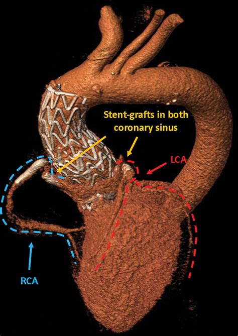 Endo-Bentall Procedure Using Off-the-Shelf Catheter Devices to Repair ...