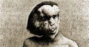 10 unusual genetic disorders in humans you won't believe are real ...