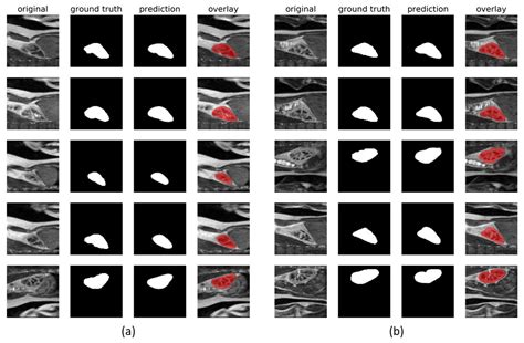 Healthy Kidney Segmentation in the Dce-Mr Images Using a Convolutional ...