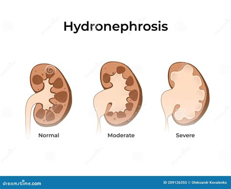 Normal Kidney with Hydronephrosis. Vector Illustration of the of the ...