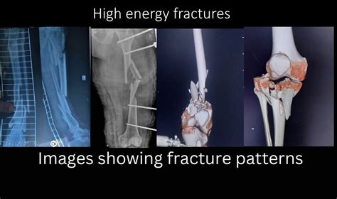 Nonunion and Management of Bone loss Treatment in Delhi