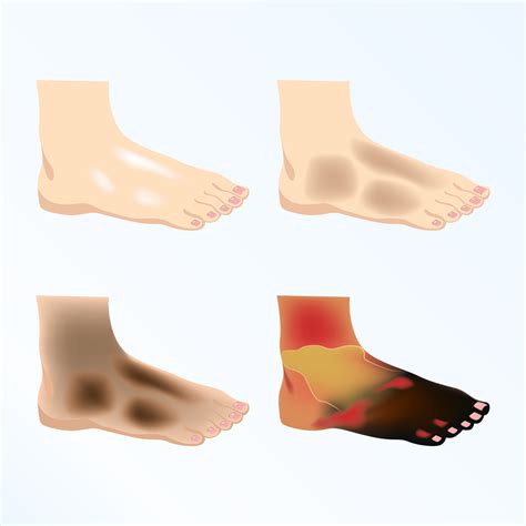 Limb Ischaemia: What Is it? What Is the Best Treatment?