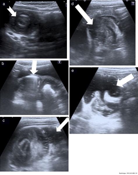 Intussusception Ultrasound Protocol