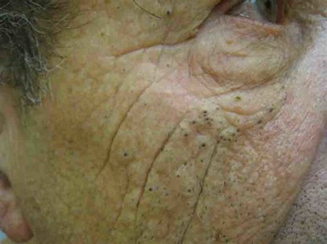 Image result for Solar Comedones Extraction