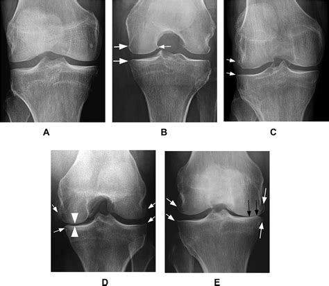 Imaging in Osteoarthritis - Osteoarthritis and Cartilage