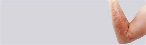 Cost of Urticaria Treatment in Bangalore | Best Clinic for Urticaria ...