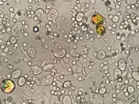 Leucine Crystals In Urine