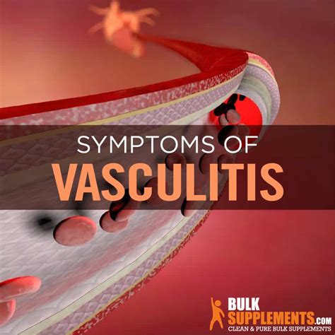 Vasculitis Symptoms New Vasculitis Guidelines: How Should You Treat