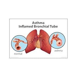 Anne Print Solutions® Asthma Inflamed Bronchial Tube Posters Without ...