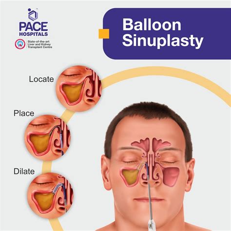 Balloon Sinusitis Surgery