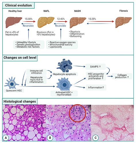 Frontiers | Liver Fibrosis in Non-alcoholic Fatty Liver Disease: From Liver Biopsy to Non ...