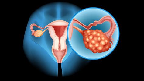 PCOS and Infertility: Symptoms, Prevention, and Treatment for Women's ...