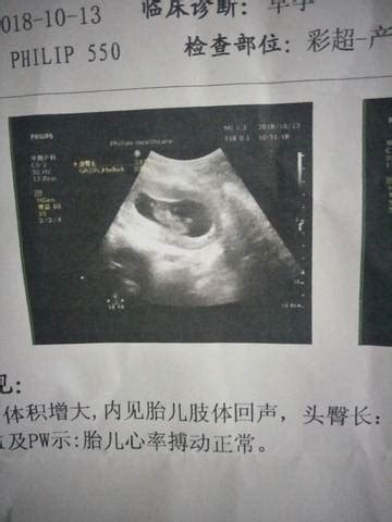 怀孕10周胎儿彩超图片,孕10周宝宝b超图片 - 伤感说说吧