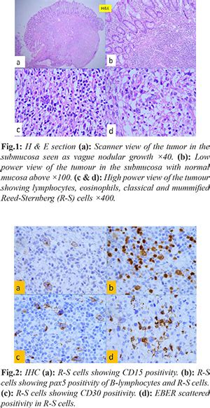 Classical Hodgkin Lymphoma Presenting as the Primary Rectal Lesion in a ...