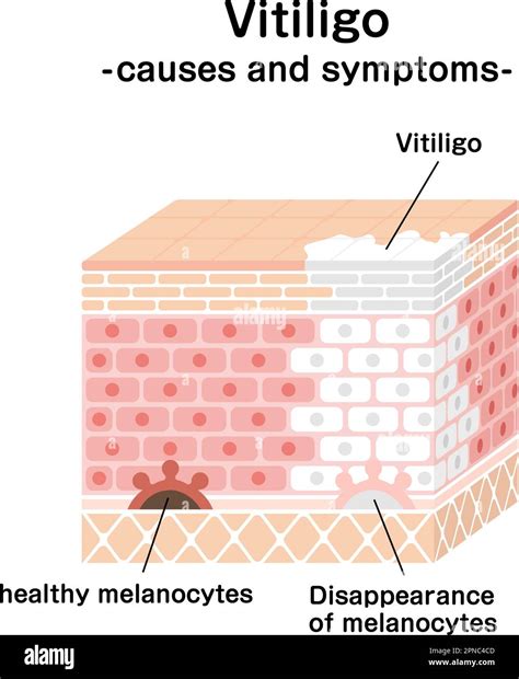 Causes and symptoms of Vitiligo vector illustration Stock Vector Image & Art - Alamy