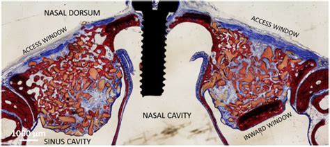 Schneiderian Membrane Collateral Damage Caused by Collagenated and Non ...