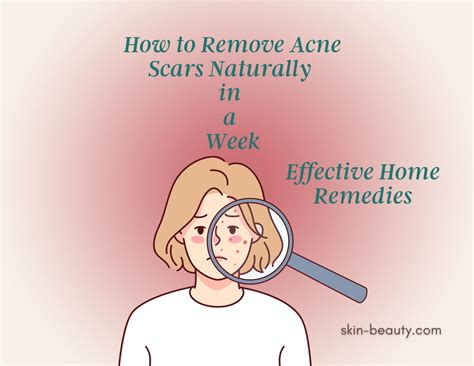 How to Remove Acne Scars Naturally in a Week - Skin Beauty