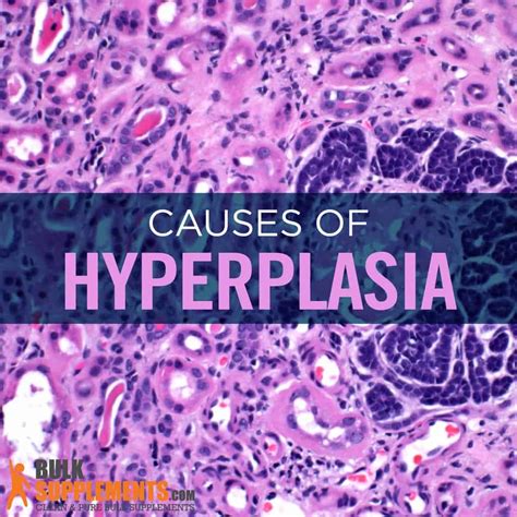 Hyperplastic Meaning Ultrasound Symptoms Of Endometrial Hyperplasia