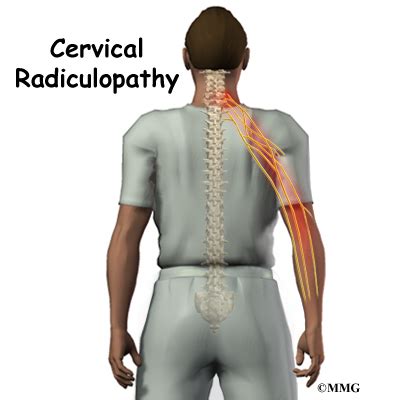 Kuvatulokset haulle cervical radiculopathy