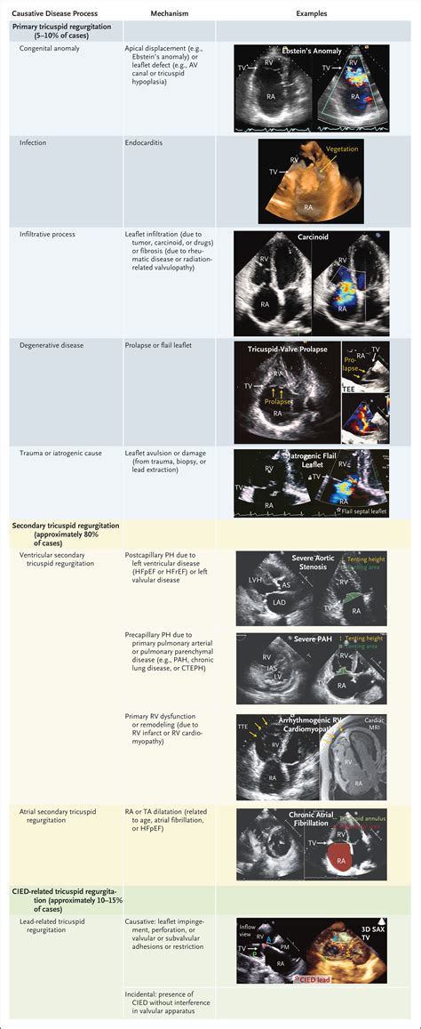 Causes Of Tricuspid Regurgitation In Children