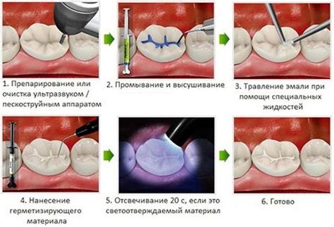Герметизация фиссур для профилактики кариеса, цена от 850 ₽ в Москве у ...