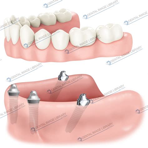 All on four. 62JW00110 | Dental Image Library