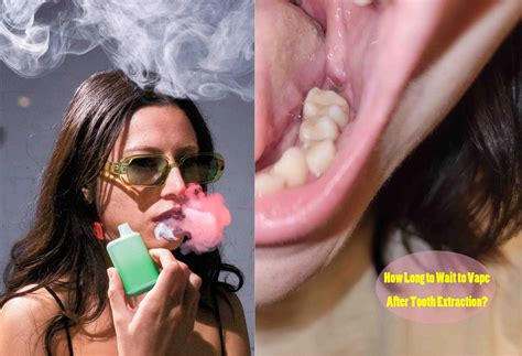 How Long to Wait to Vape After Tooth Extraction?