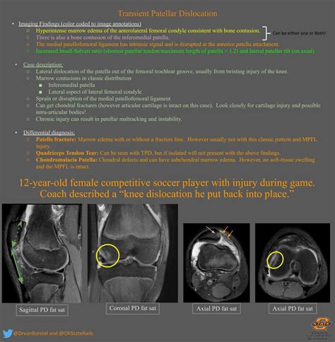 How To Fix Patellar Tilt at Victoria Horton blog