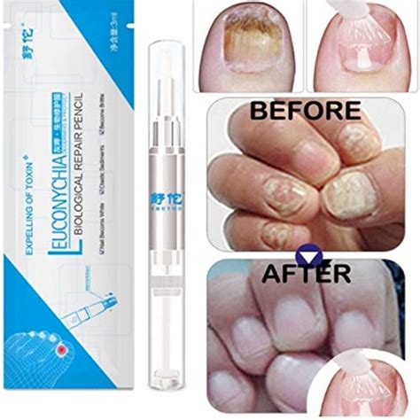 Buy 3ML Fungal Nail Pen Onychomycosis Paronychia Anti Fungal Nail ...