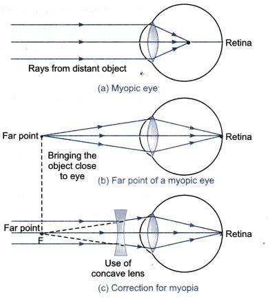 What is myopia? State the two causes of myopia - CBSE Class 10 Science ...