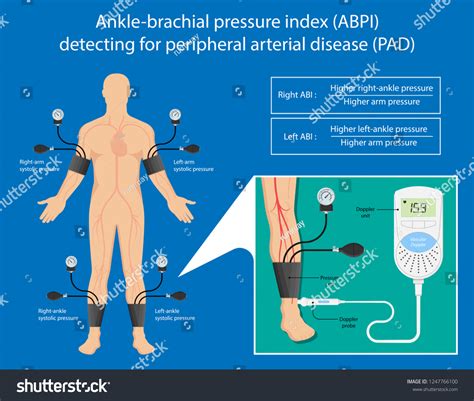 What Is An Abi Test | Renew Physical Therapy