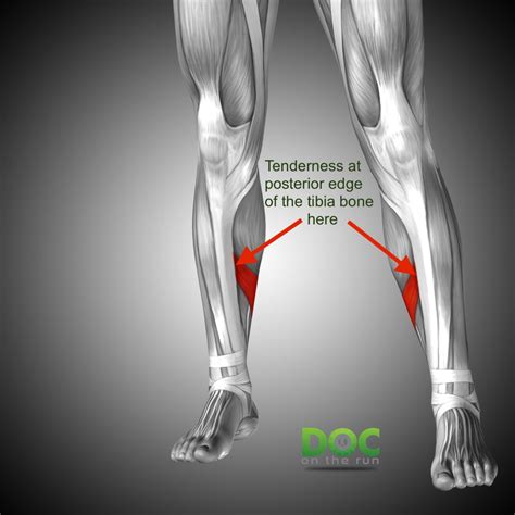 Tibia stress fracture treatment - inrikoguide