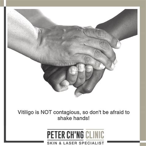 5 Myths and Misconceptions About Vitiligo You Misunderstood | Peter Ch'ng Skin Specialist - KL ...