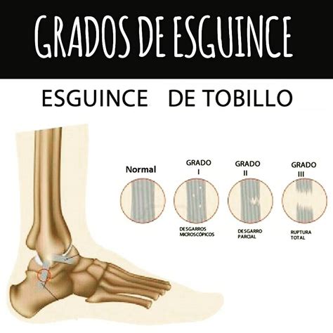 Esguince De Primer Grado : Atención postratamiento para el esguince de ...