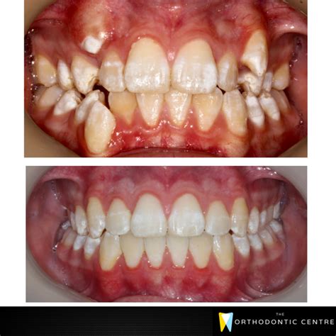 Crooked Teeth Without Braces