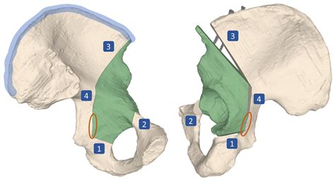 Augmented Reality Based Surgical Navigation of Complex Pelvic ...