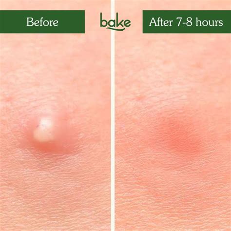 Buy BAKE Zit Erase Micro point Patches for Active Acne, Unclogs Pores ...